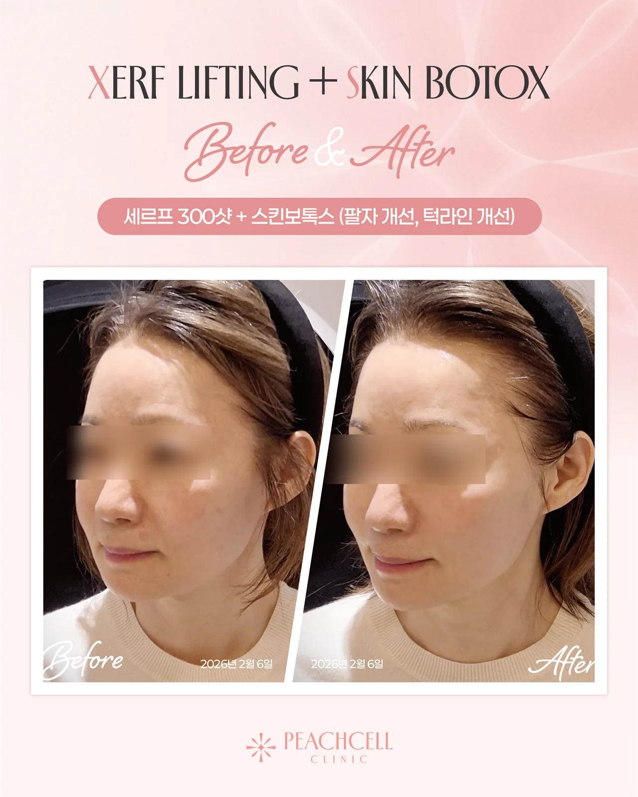 Serf 300 shots + Skin Botox — 50s female