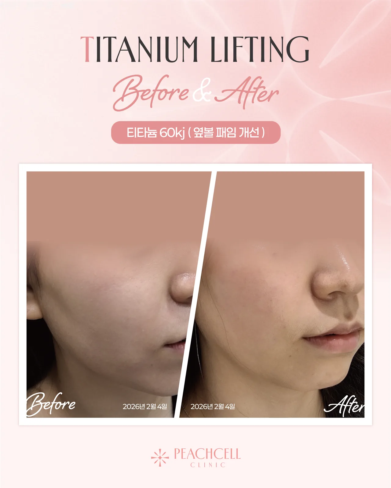 Titanium — 30s female