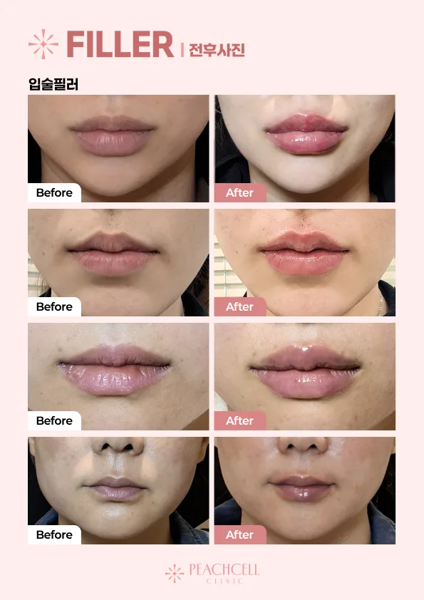 Lip filler — before and after