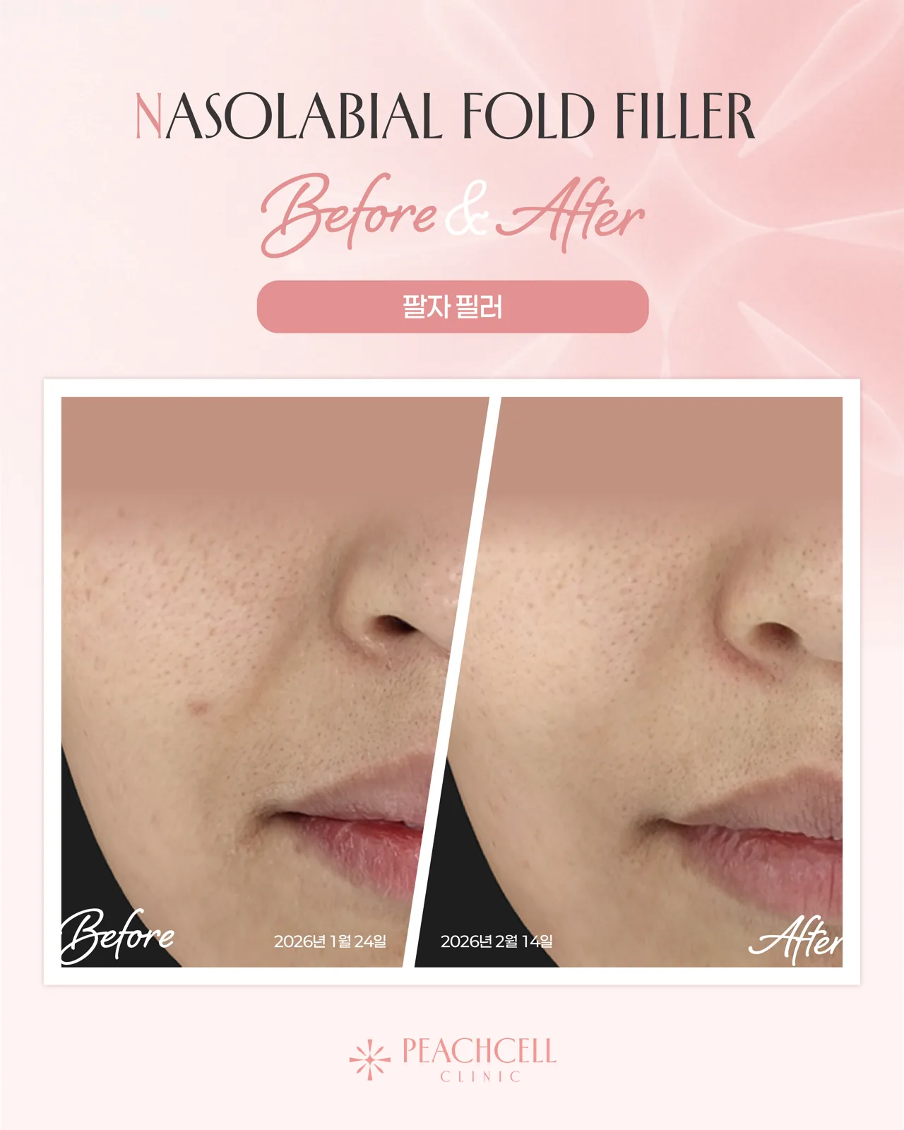 Nasolabial filler — 30s female