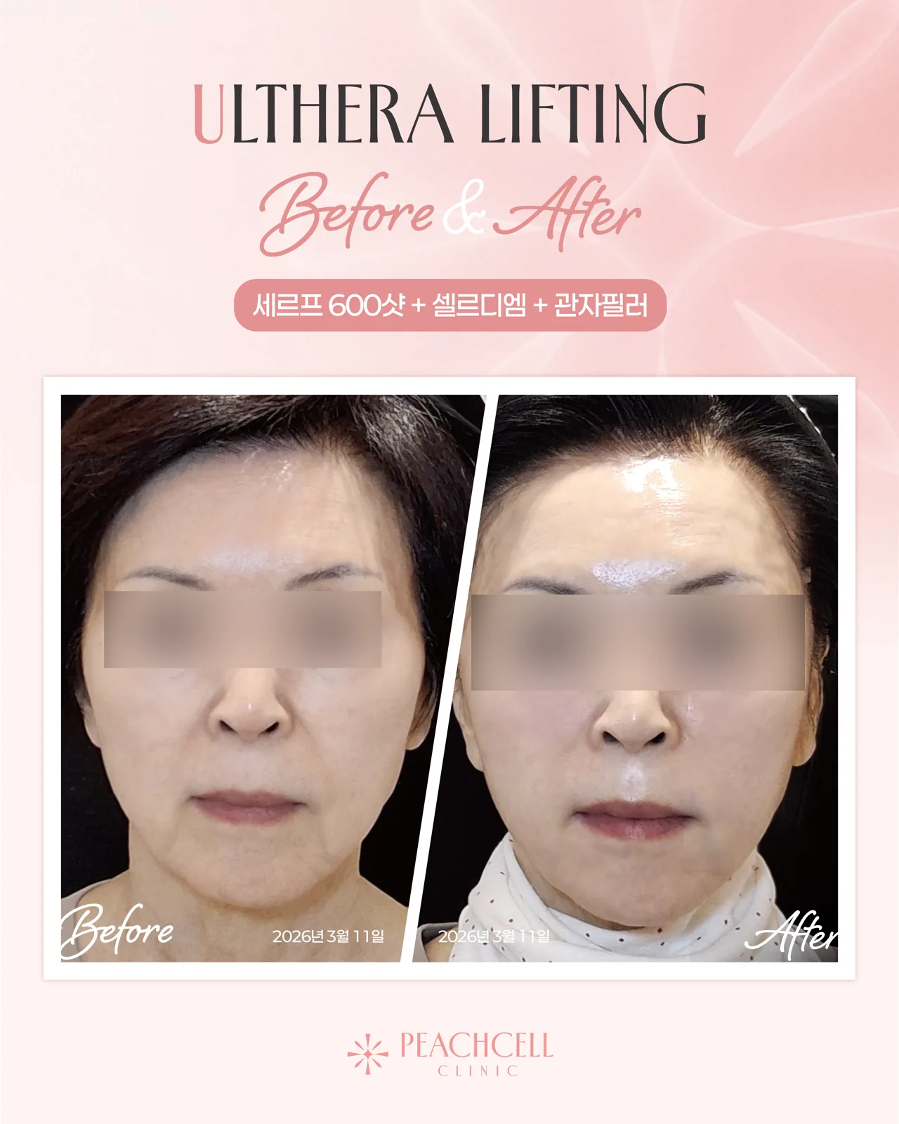 Serf 600 shots + CellREDM + Temple filler — 60s female