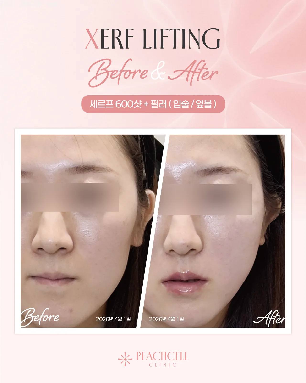 Serf 600 shots + Filler — 30s female