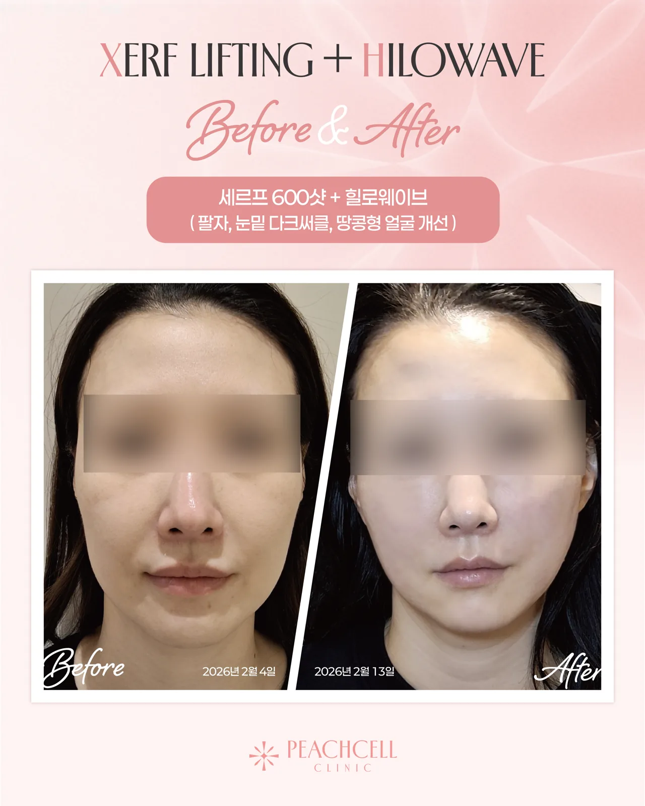 Serf 600 shots + HILO Wave — 30s female