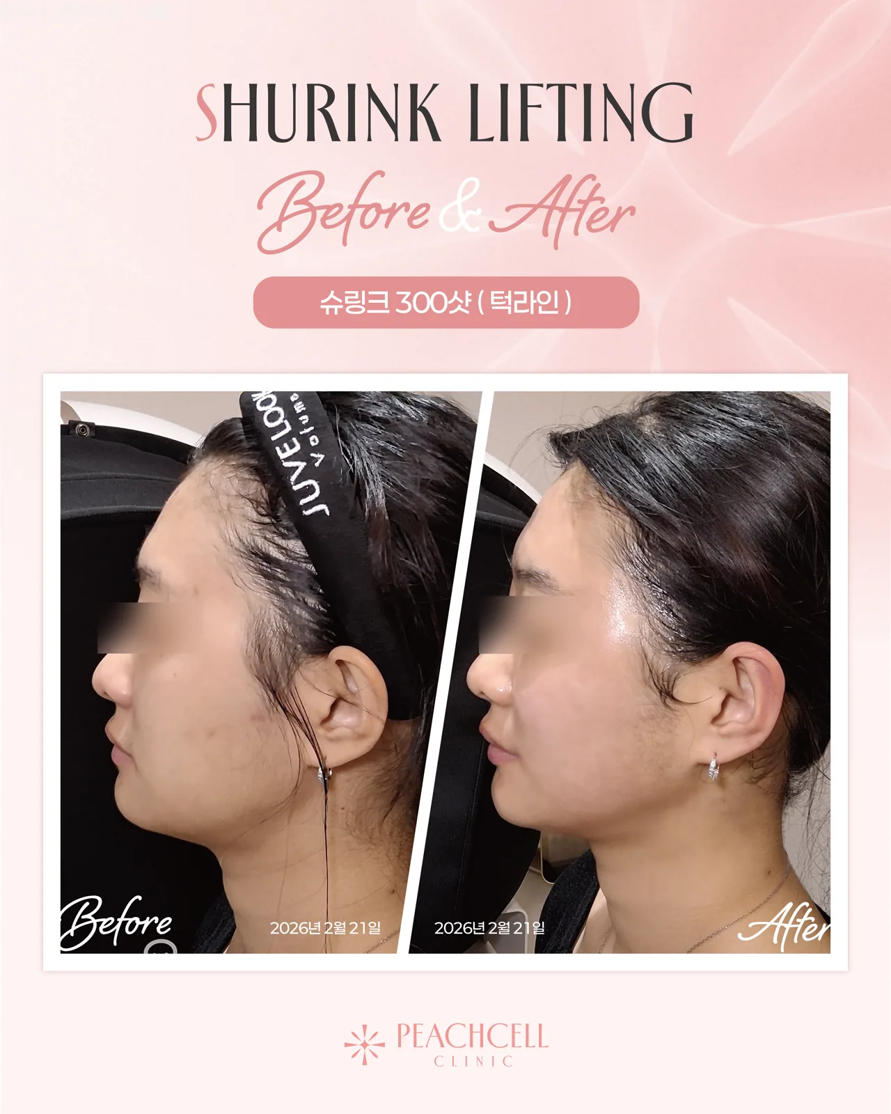 Shurink 300 shots — 20s female