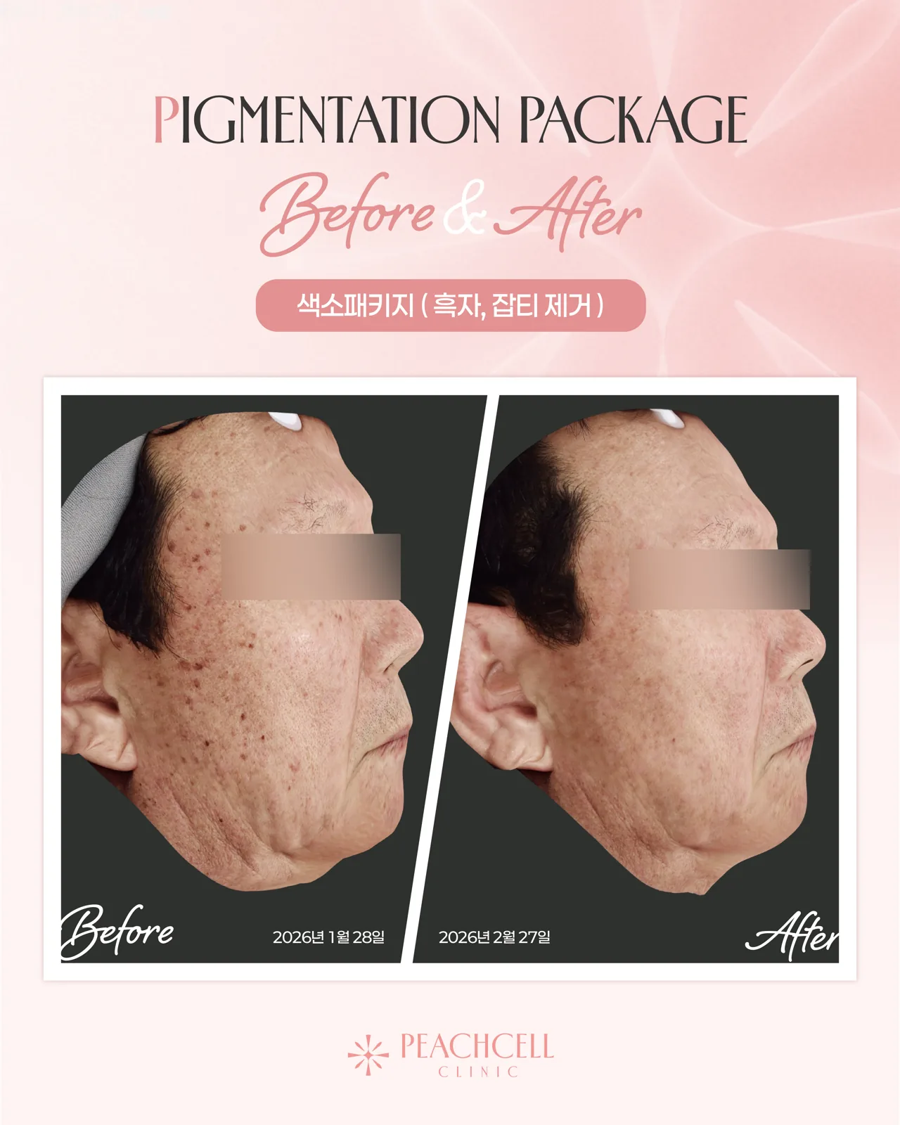 Pigmentation removal — 60s male